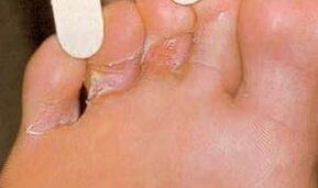 Dermaid lesions to foot mycosis