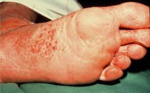 Mushroom on his feet with ulcers