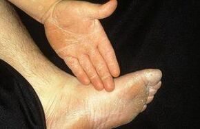 The deleted form of mycosis is manifested by peeling