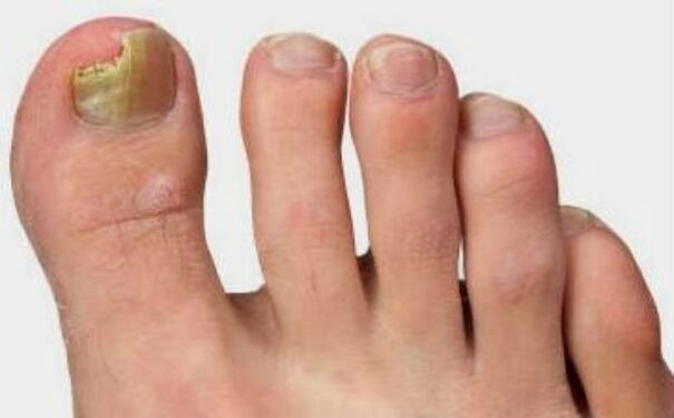 The mushroom on the thumb of the foot