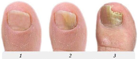 The process of mushroom development in the thumb