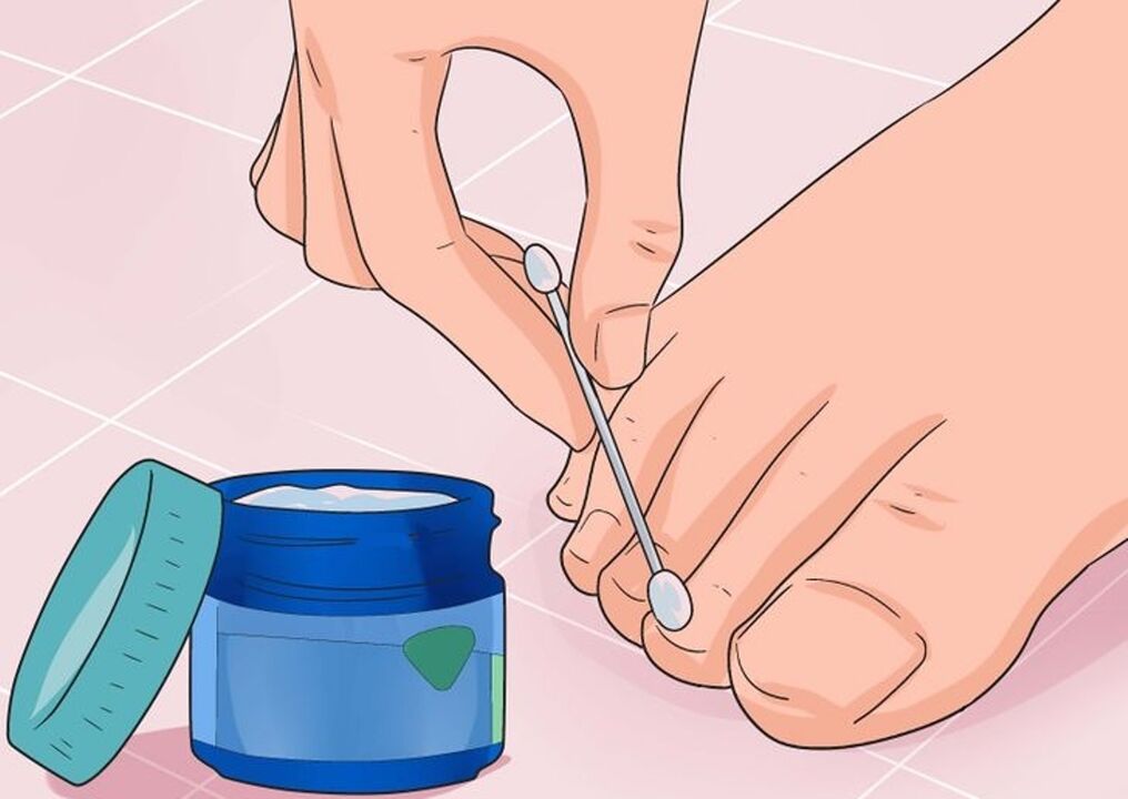 Heal the nail fungus
