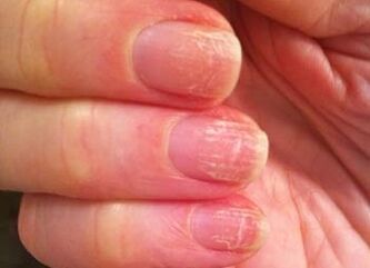 The initial stage of the mushroom on the nails