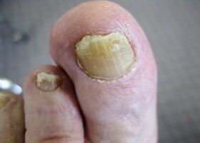 The reasons for the appearance of the fungus on the nails
