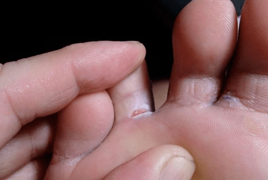The appearance of bubble formations on the leg