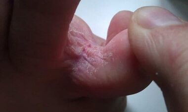Stages of mushroom development between the toes