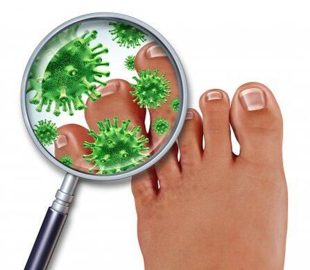 fungal infection on the foot