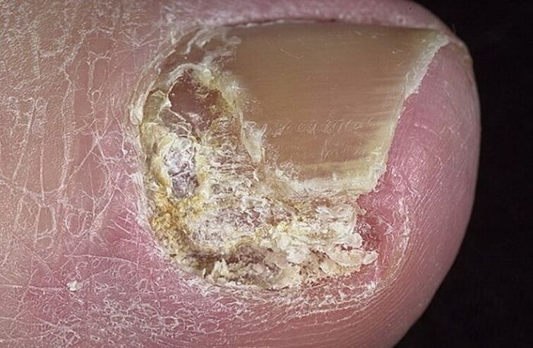 Types of Onychomycosis