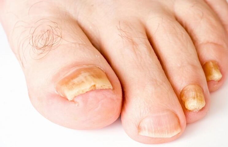 yellow toenails due to fungus