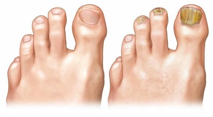 healthy nails and nail fungus