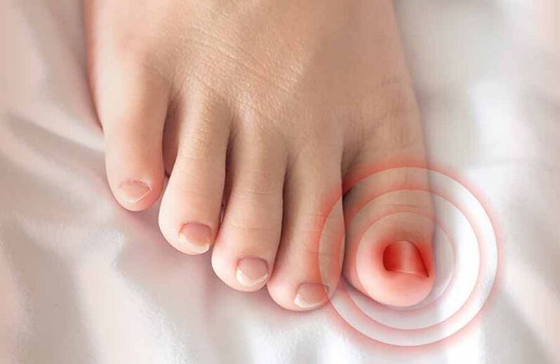 ingrown toenail