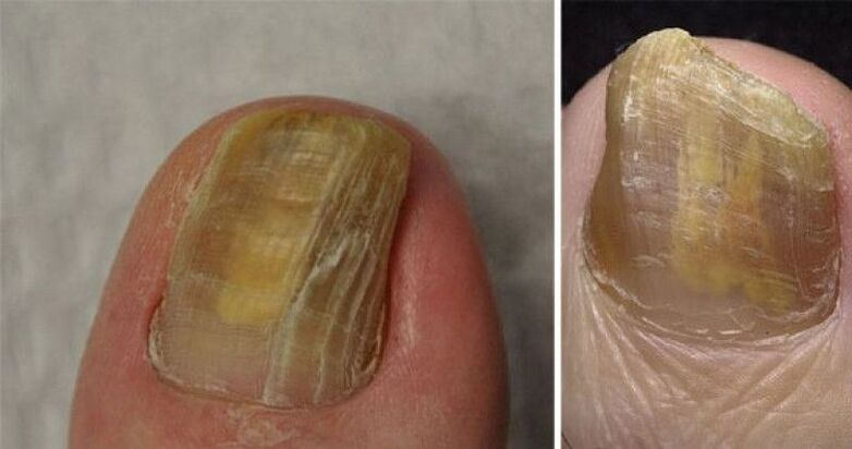 onychodystrophy of nails