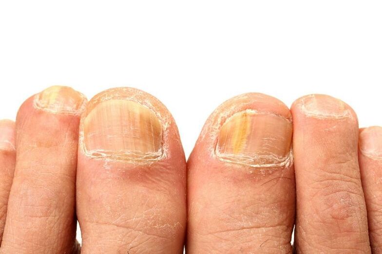 onychomycosis on the nails