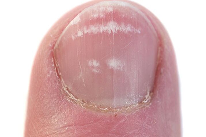 signs of fungus on the nails